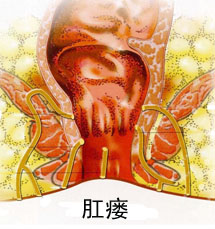 肛瘘图片