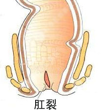 肛裂图片