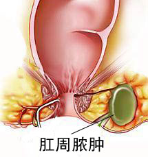 肛周脓肿图片